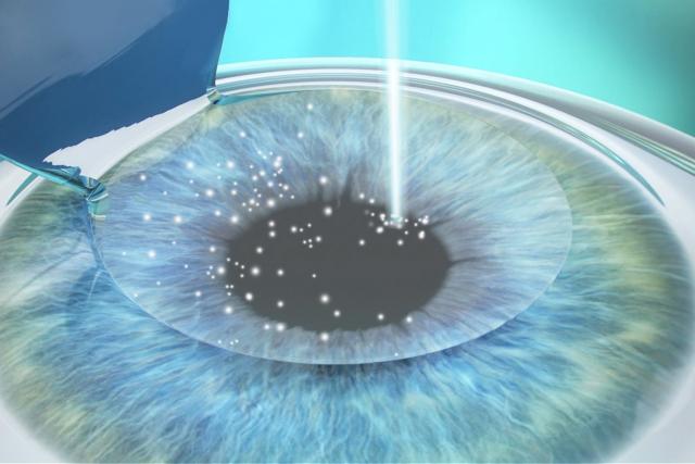 Medifocus Femto LASIK
