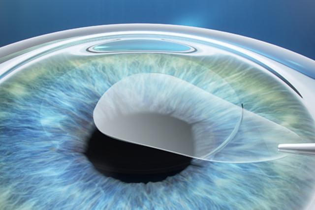 Medifocus ReLEx smile