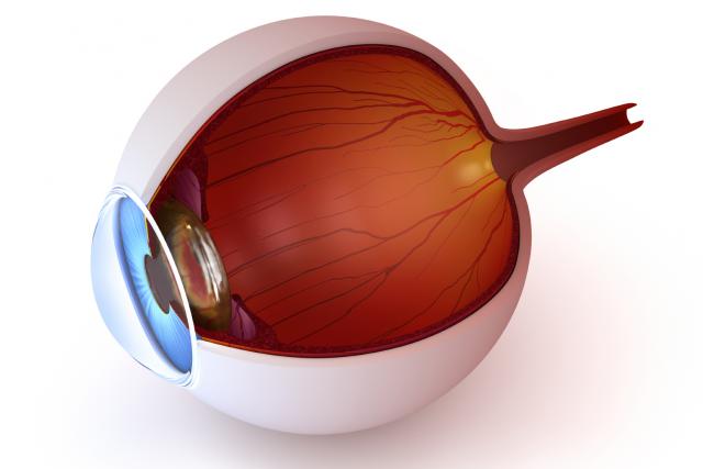 Medifocus cataract chirurgie